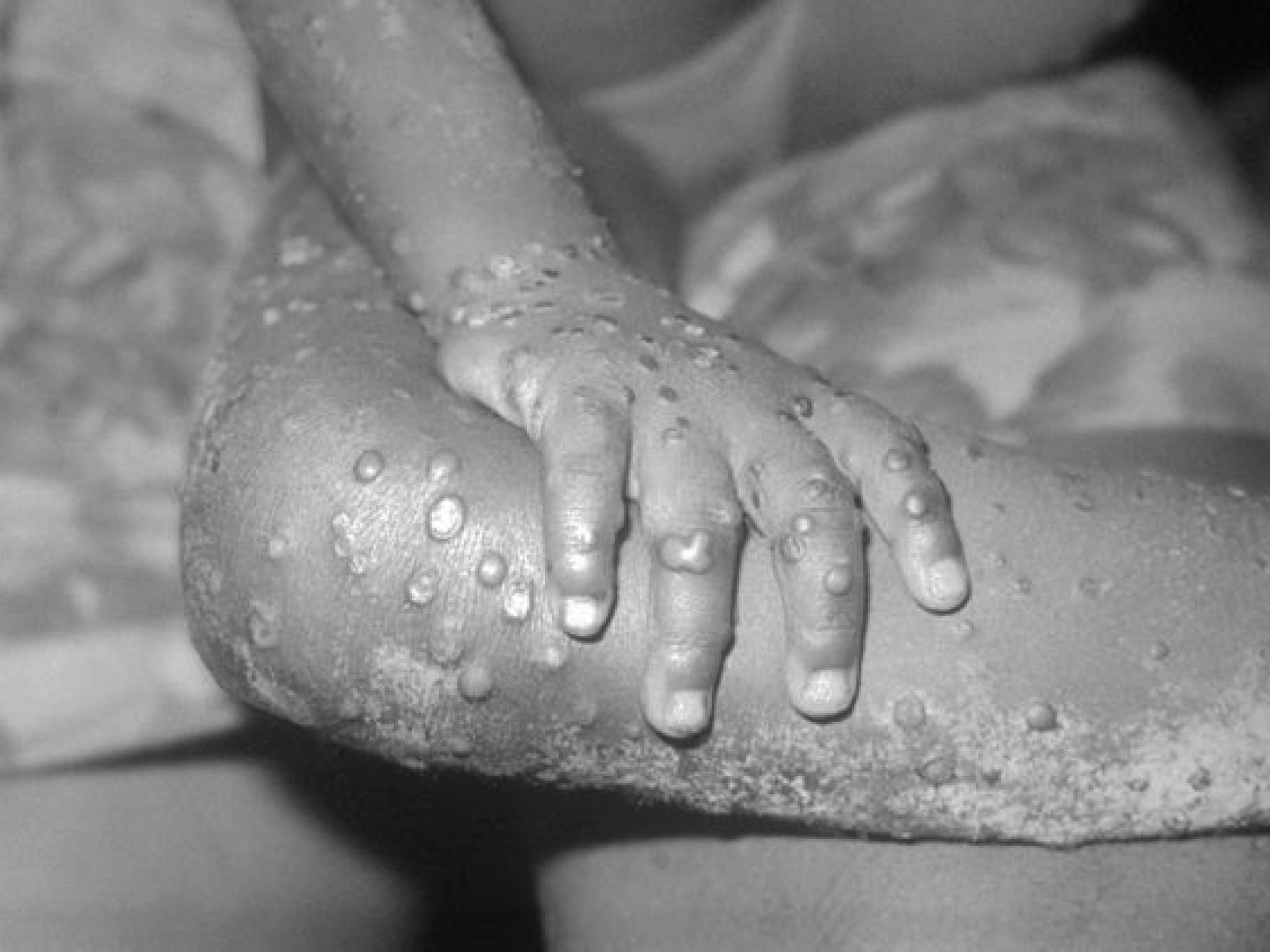  analysis-should-you-be-afraid-of-a-monkeypox-pandemic 