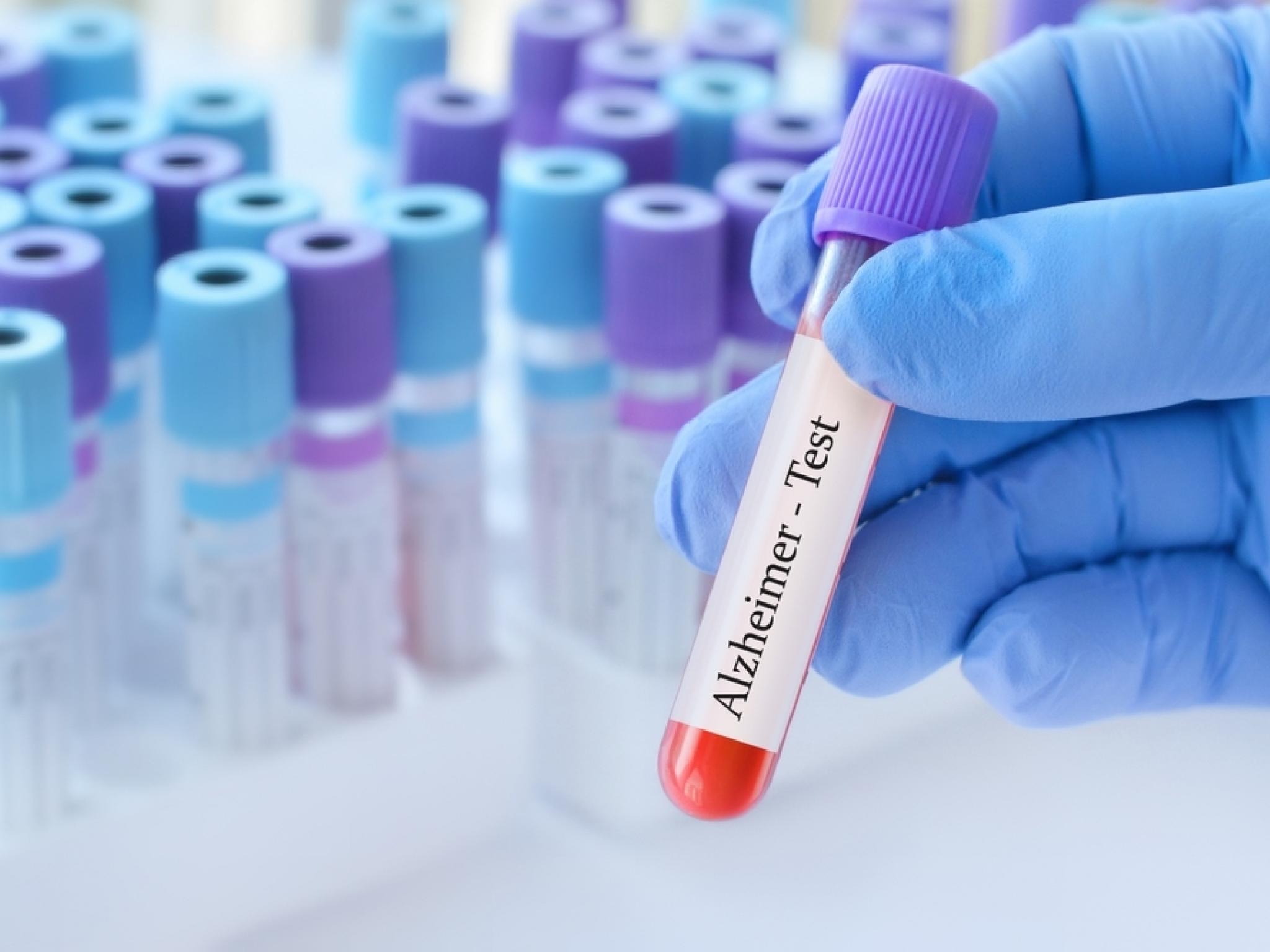 Le candidat médicament contre la maladie d’Alzheimer d’Anavex Life Sciences montre des bénéfices à long terme continus par rapport au groupe témoin