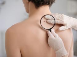  melanoma-data-study-boosts-jj-partner-nanobiotix-stock-on-thursday 