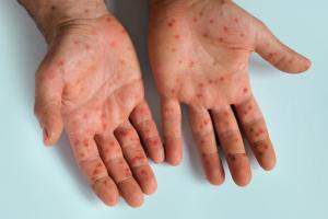 Atopic Dermatitis