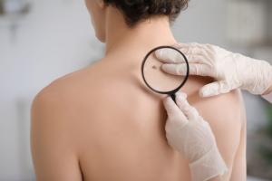 Dermatologist examining for melanoma on young man's back with magnifier in clinic, closeup