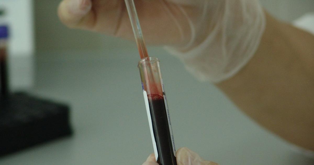 AnPac Bio-Medical Science Co. Ltd. Announces Study Results Confirming Correlation Between CDA Score, Risk of Cancer