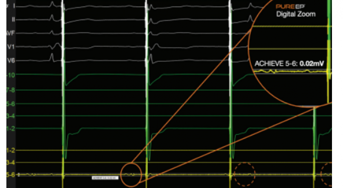 BioSig Technologies Inc. Reports Increased Adoption of its Signal Processing Technology for Arrhythmia Care