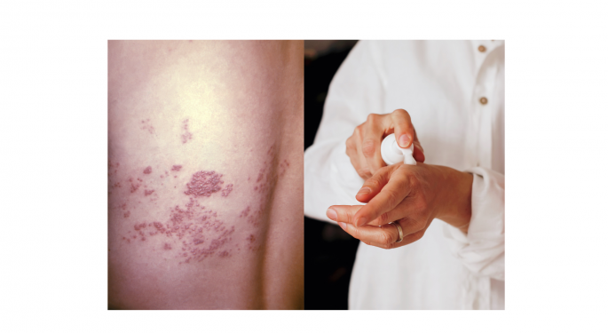 Pharmaceutical Companies Are Reportedly Refocusing On Mysterious Rise In Shingles Infections As COVID Declines