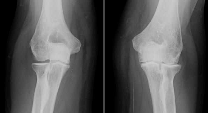 Pfizer And Eli Lilly's Osteoarthritis Drug Rejected By FDA Panel As Too Risky