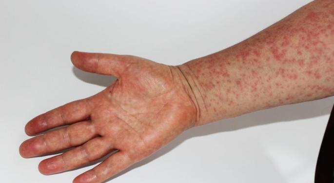 Measles Cases Surge 5x In US In A Week, CDC Reports: Outbreak Primarily Originating From A Texas County