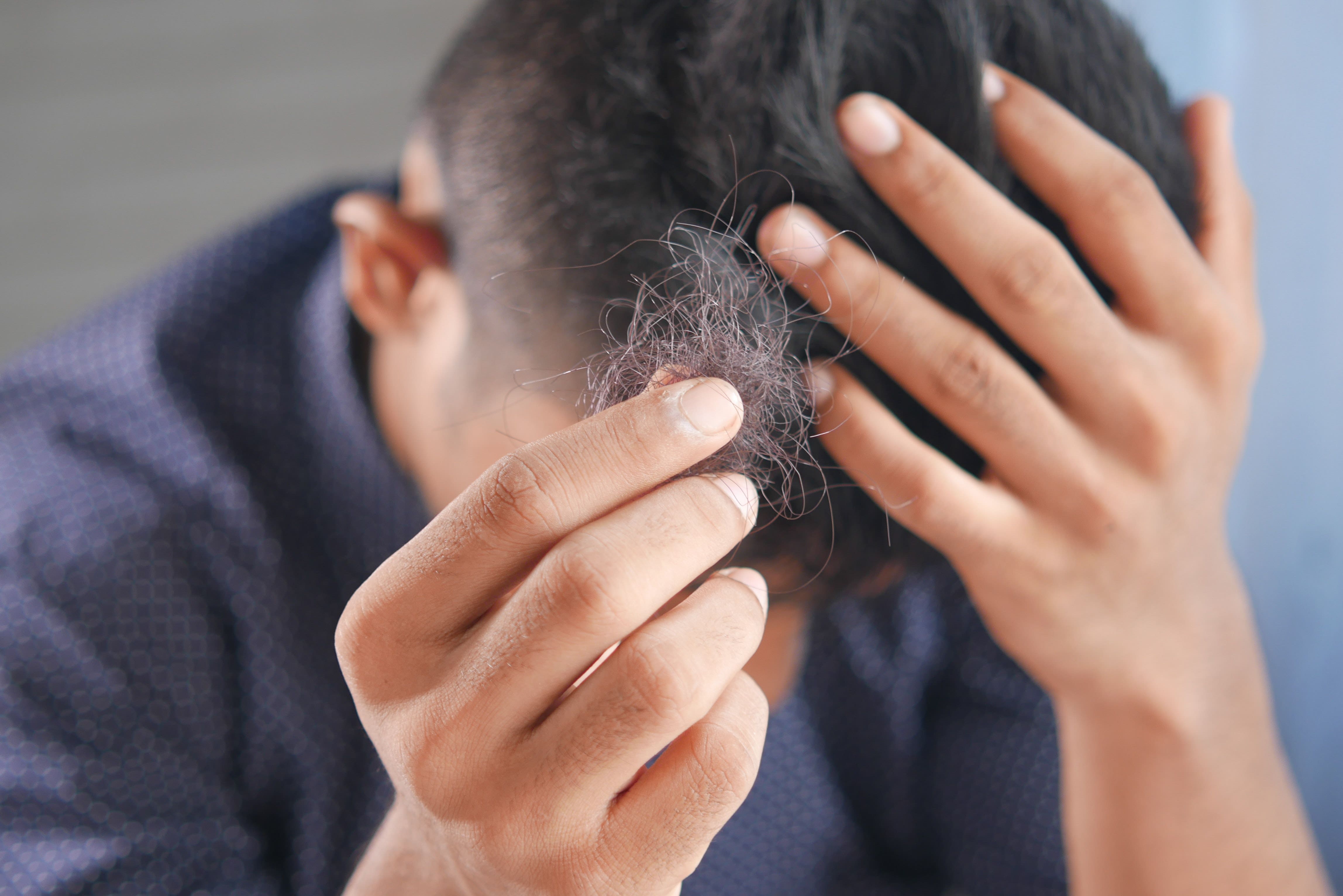 Hair Thinning? Britannia Life Sciences Launches CBD Trial For Hair Loss Treatment