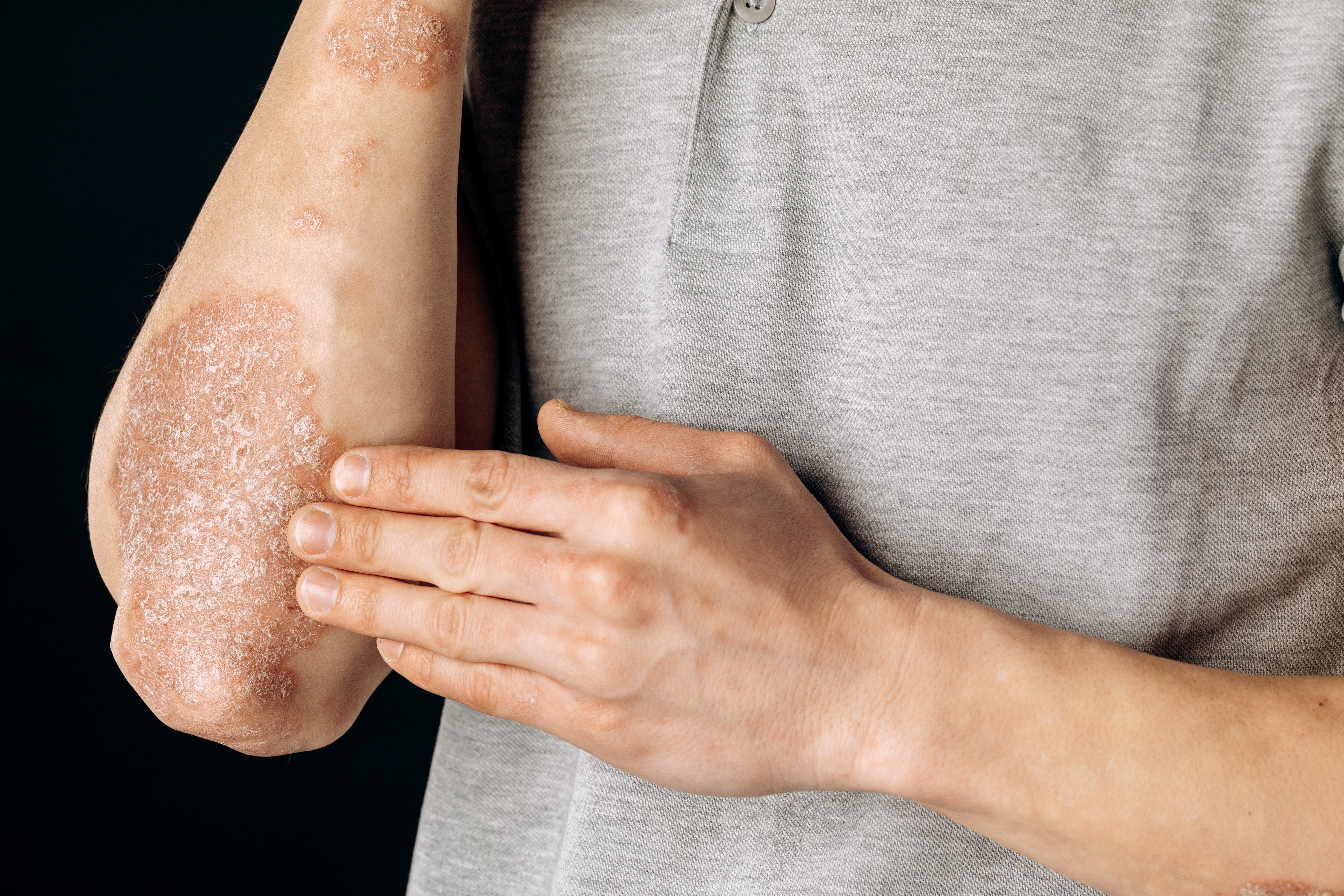 This Company Is Racing Toward Providing Comfort And Safety To Millions Of Psoriasis Sufferers