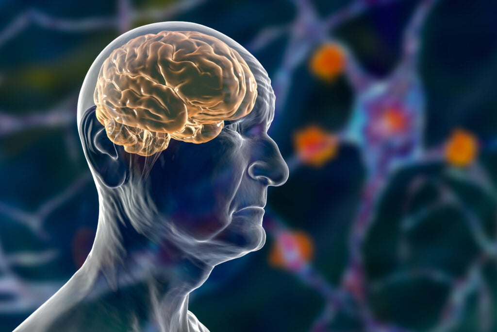 Clinical Failure Halts Alector's Dementia Program, Company Reduces Workforce